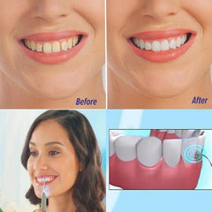 Ultrasonic Teeth Cleaner Remove Plaque, Tartar, Stains