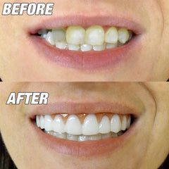 Perfect Smile Teeth Veneers